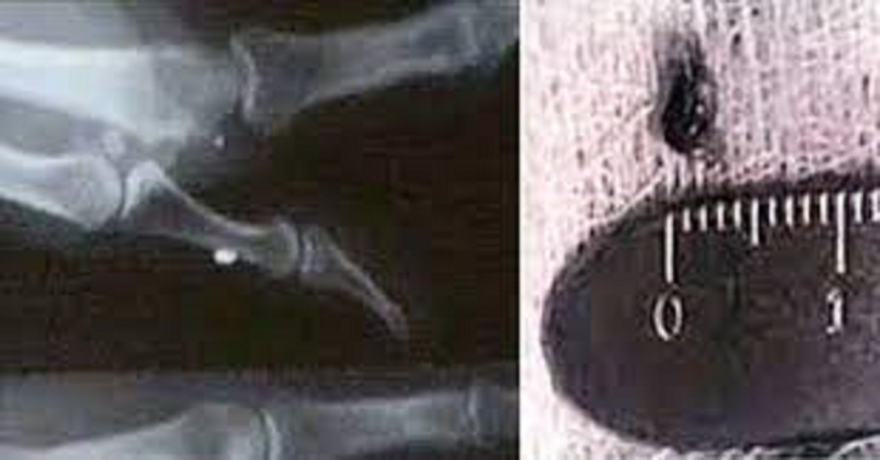 Real X-ray composite from the Tim Cullen case. The left panel is a radiograph of Cullen's hand showing a small dense foreign object lodged in the soft tissue near a joint, the object first noted by Dr. Mark Hubner at the Yuma Clinic in 1998. The right panel is a microscope photograph of the roughly 7 by 4 millimeter object after surgical removal, shown against a millimeter ruler. This is documentary medical imagery, not a recreation or render.